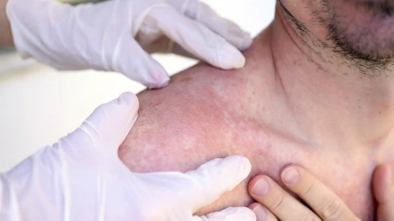 Las enfermedades dermatológicas tienen más probabilidades de causar problemas mentales