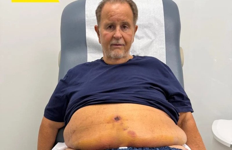 Se somete a abdominoplastia por exceso de piel: