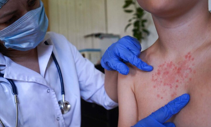 Infectología alerta a RD sobre riesgo de sarampión