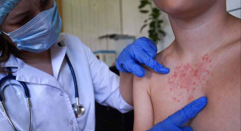 Infectología alerta a RD sobre riesgo de sarampión