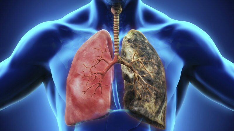 Cáncer de pulmón en adultos jóvenes que nunca han fumado