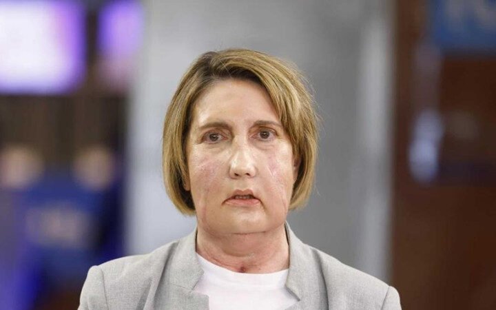 Primer trasplante facial del mundo con donante que recibió la eutanasia en Barcelona