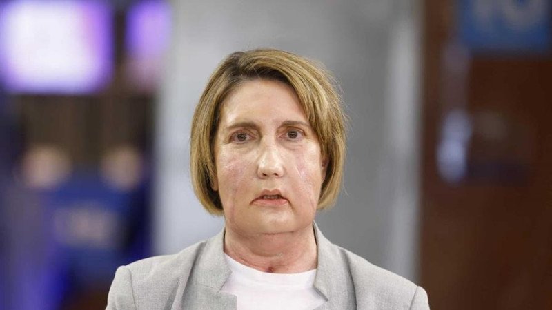 Primer trasplante facial del mundo con donante que recibió la eutanasia en Barcelona