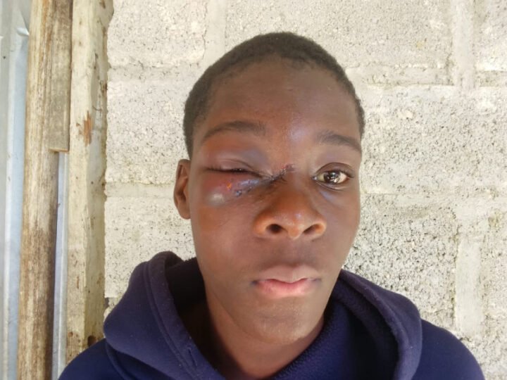 Otra agresión policial en un ojo de un joven durante operativo en San Luis